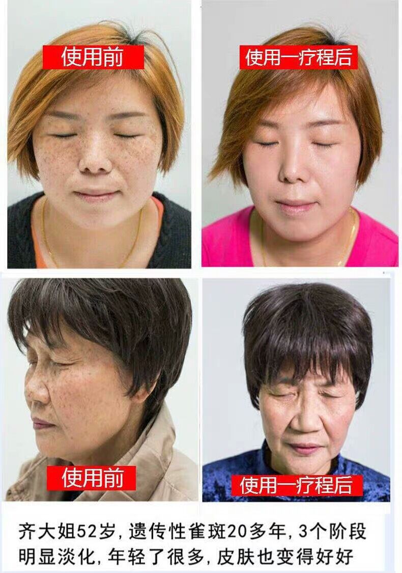 富勒烯祛斑原液